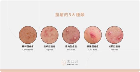 女生長痘痘|痤瘡是什麼？種類、成因、治療方式 一篇看懂